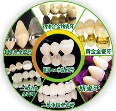 黄金烤瓷牙的价钱