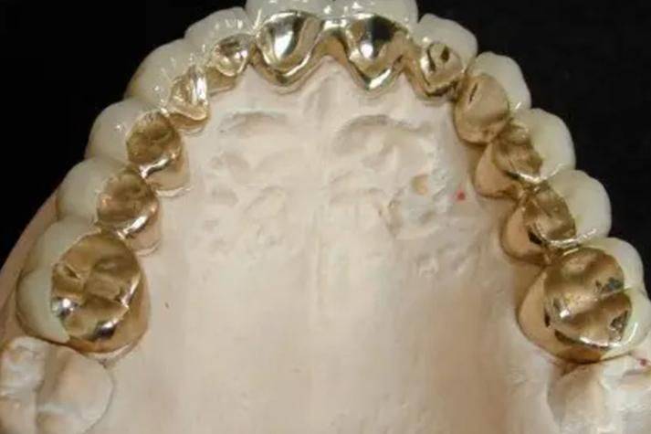 黄金烤瓷牙的价钱