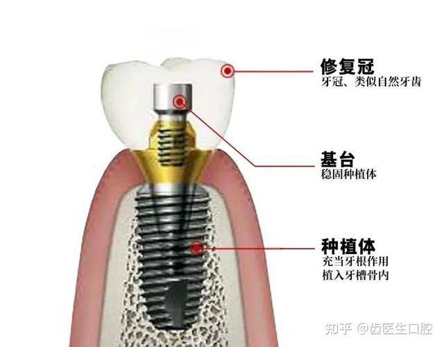 一颗种植牙多少钱