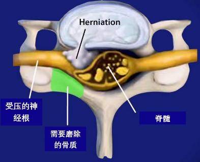 治疗颈椎病有哪些方法