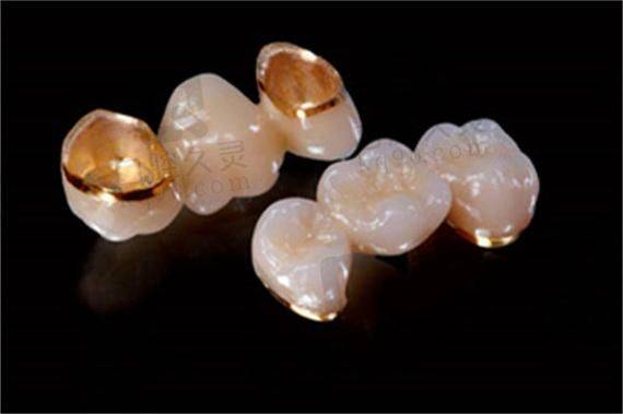 黄金烤瓷牙的价钱