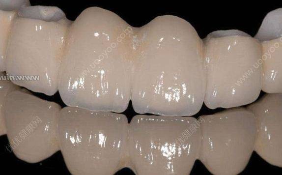 黄金烤瓷牙的价钱