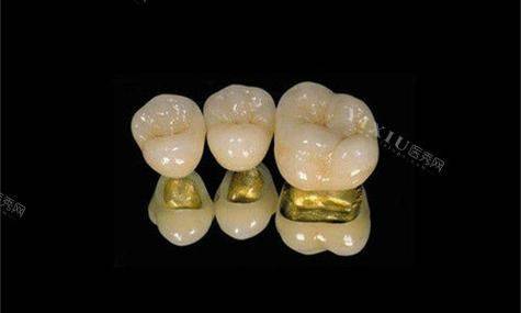 黄金烤瓷牙的价钱