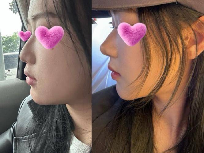 朝天鼻矫正多少钱