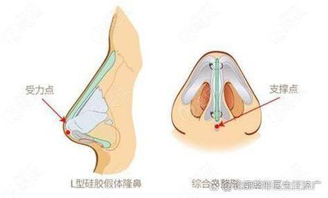 朝天鼻矫正多少钱