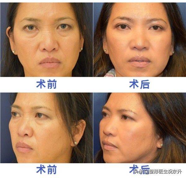 How much for eyebag surgery