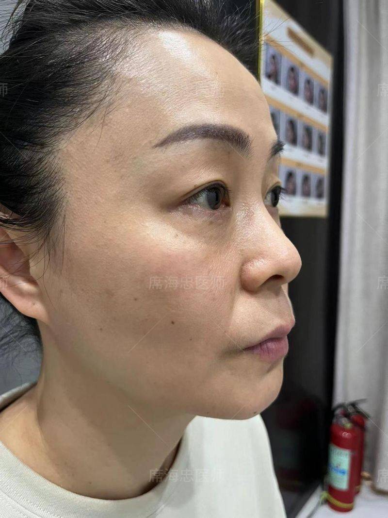 做去眼袋手术多少钱