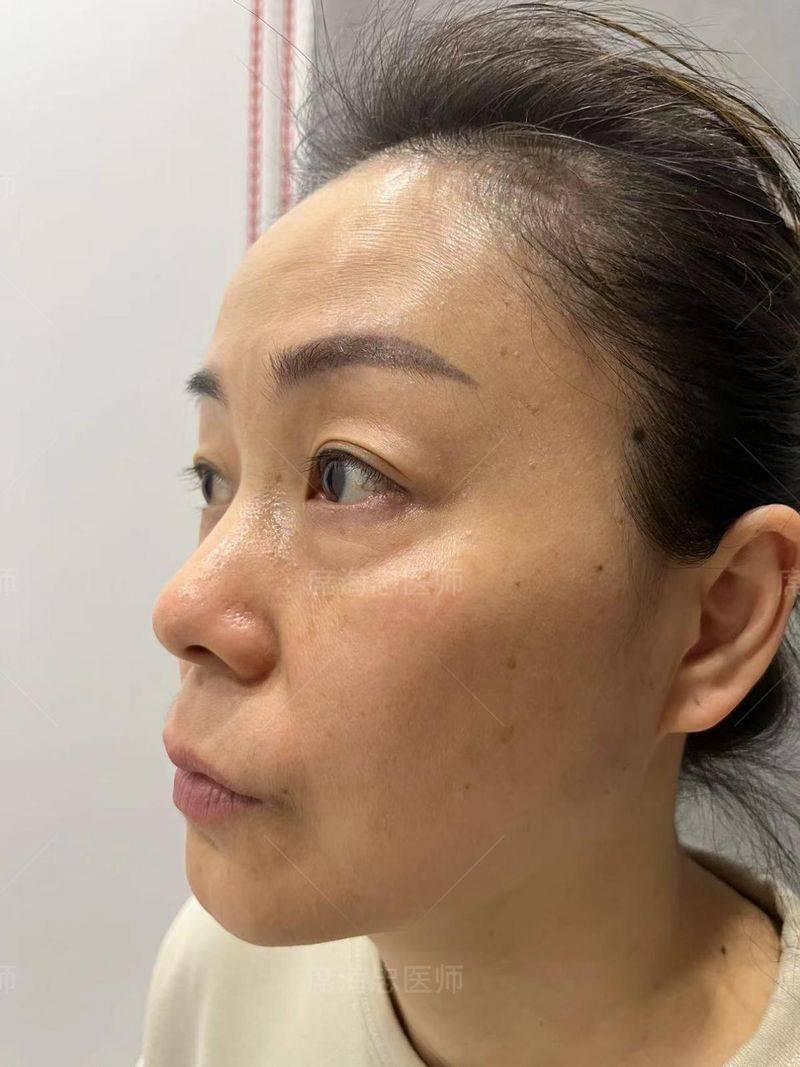 做去眼袋手术多少钱