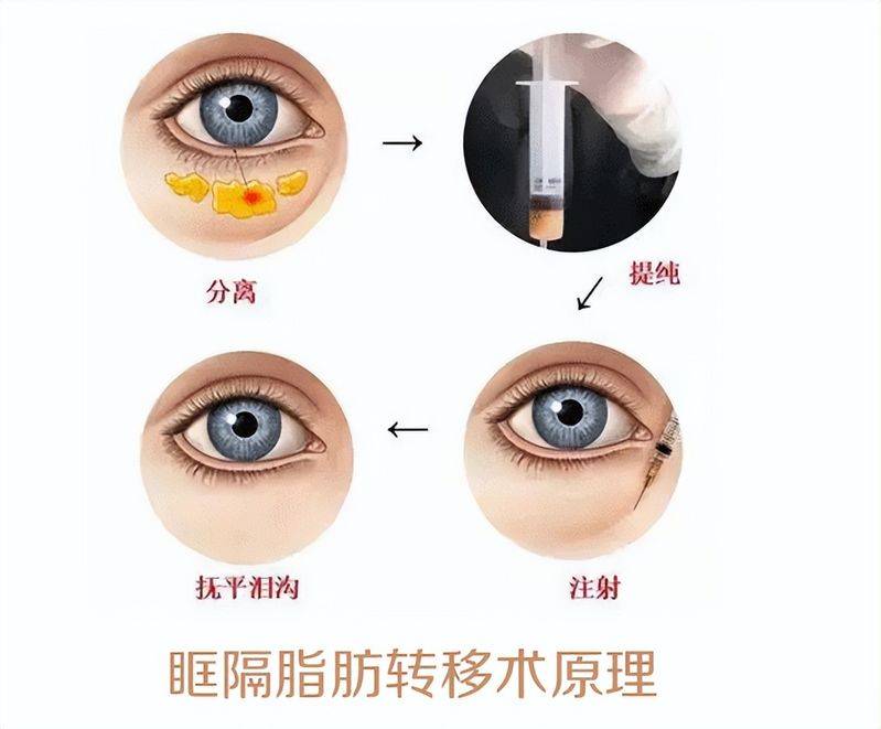 做去眼袋手术多少钱