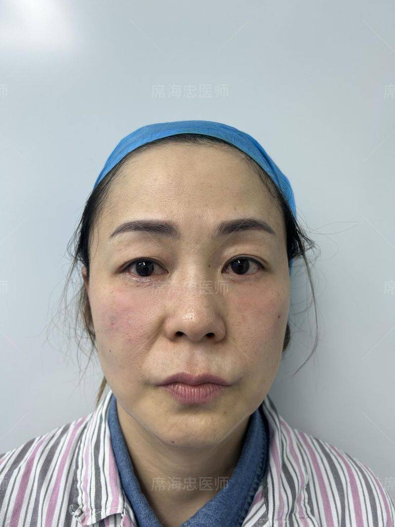 做去眼袋手术多少钱