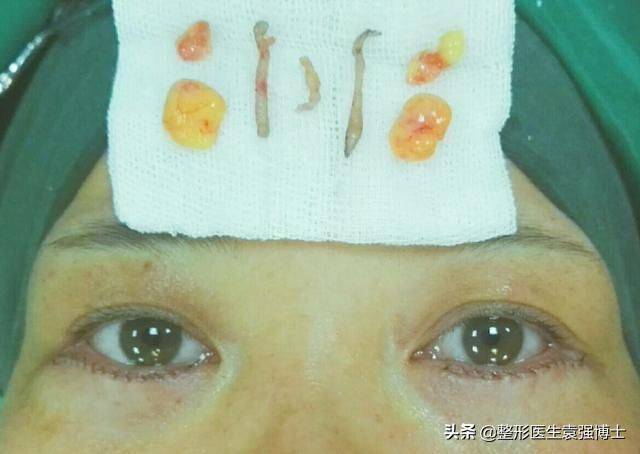 做去眼袋手术多少钱