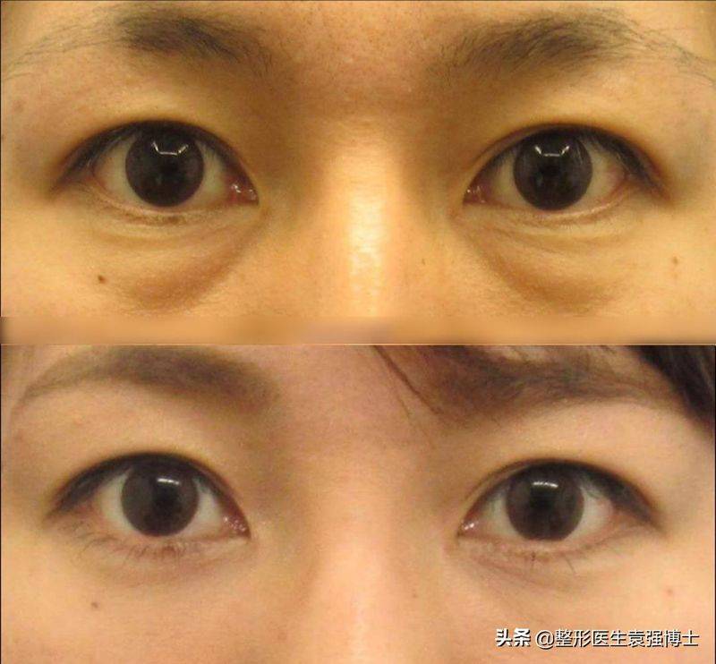 做去眼袋手术多少钱