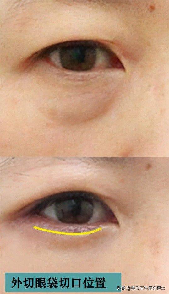 做去眼袋手术多少钱