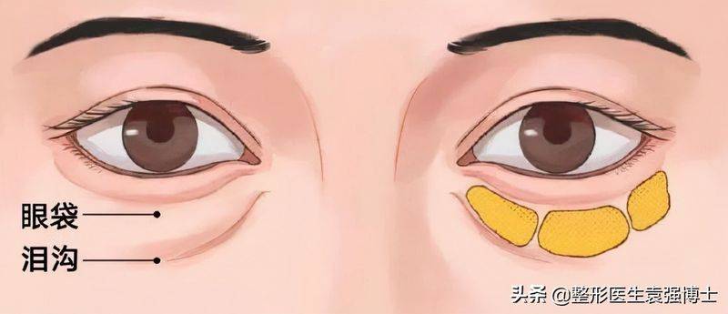 做去眼袋手术多少钱