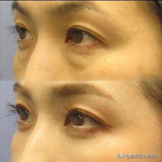 How much for eyebag surgery