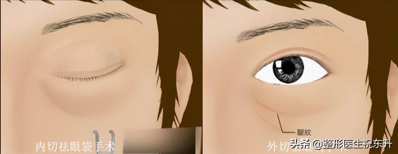 How much for eyebag surgery