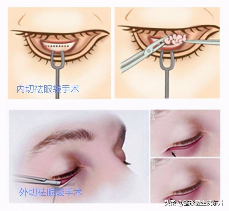 How much for eyebag surgery