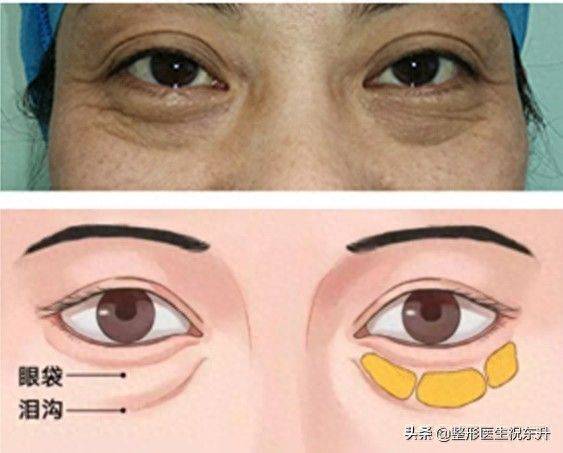 做去眼袋手术多少钱