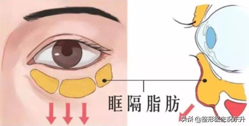 做去眼袋手术多少钱