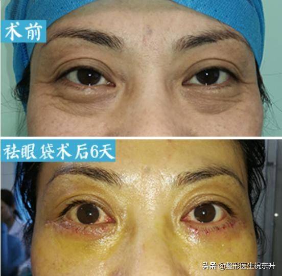 做去眼袋手术多少钱