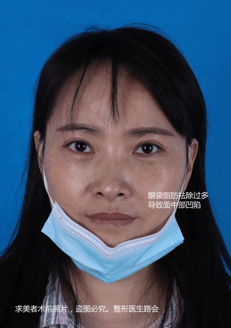 做去眼袋手术多少钱