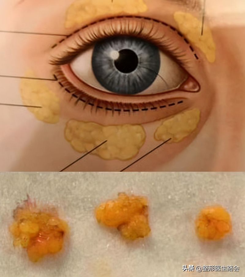 做去眼袋手术多少钱