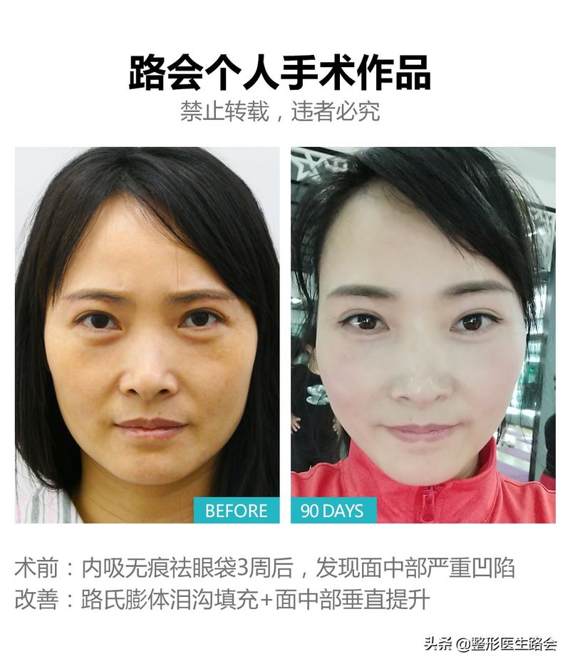 做去眼袋手术多少钱