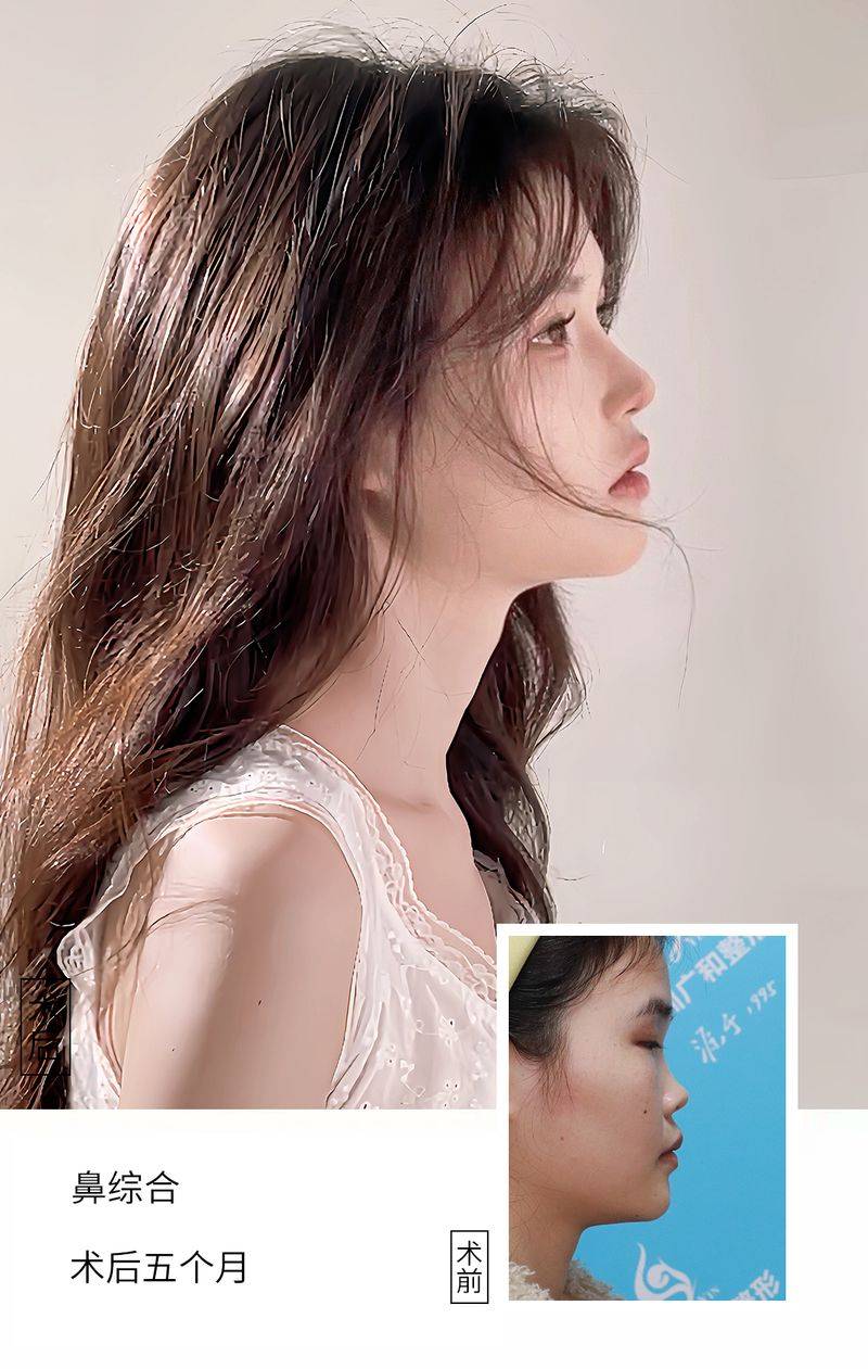 鼻头缩小 多少钱