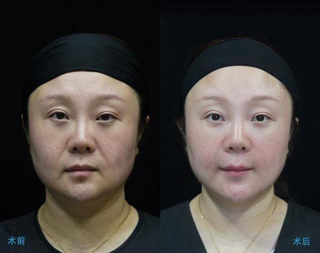 脸部激光溶脂多少钱