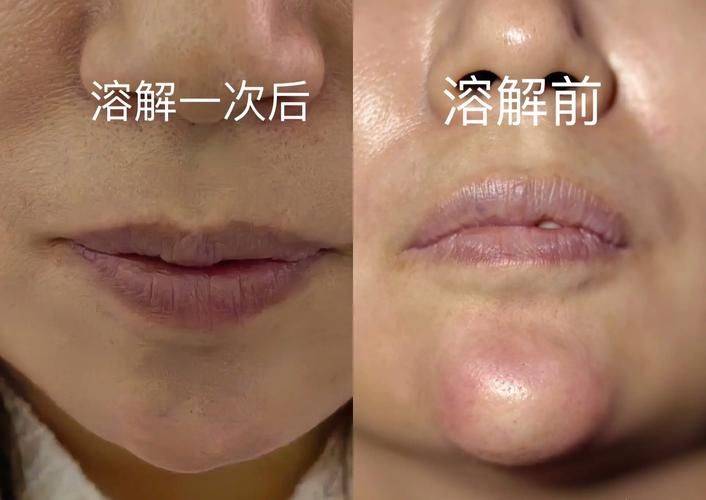 脸部激光溶脂多少钱