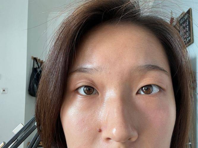 苏州割双眼皮多少钱