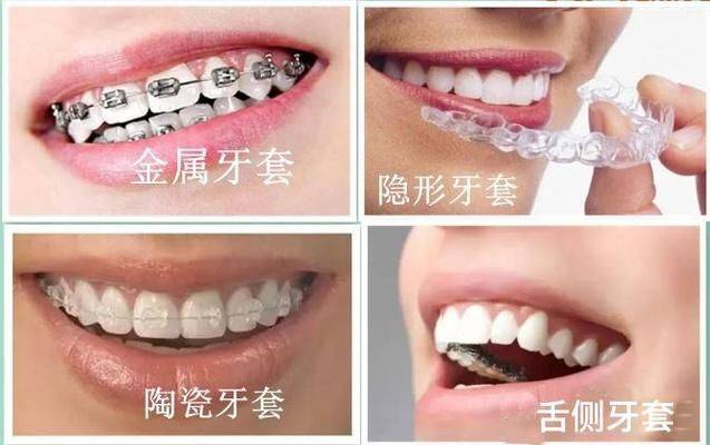 自锁牙套大概多少钱