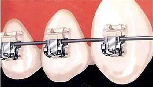 自锁牙套大概多少钱