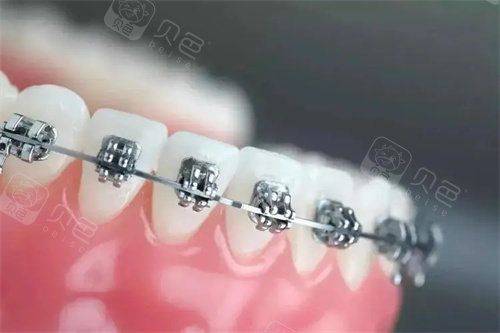 自锁牙套大概多少钱