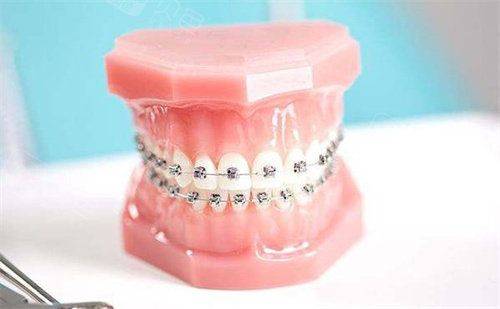 自锁牙套大概多少钱