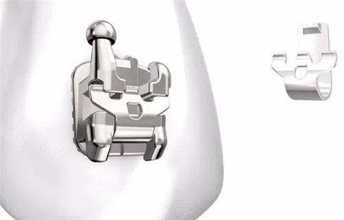 自锁牙套大概多少钱