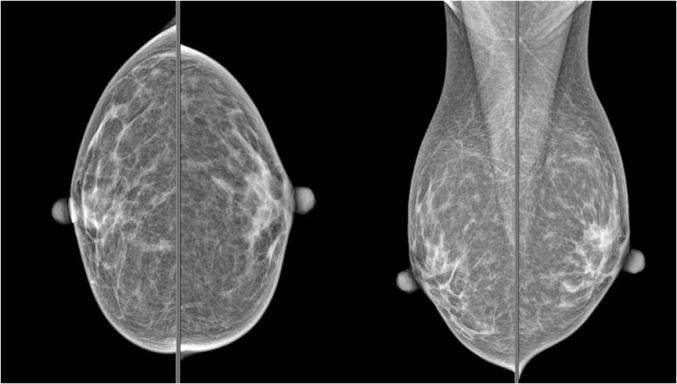 乳房钼靶检查多少钱