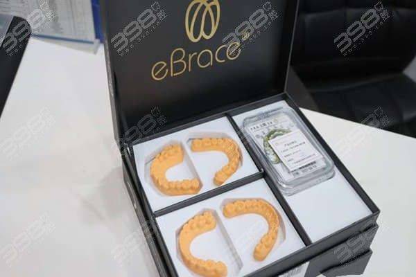 自锁牙套大概多少钱