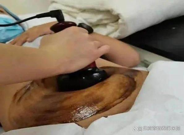 中医治疗肿瘤经验