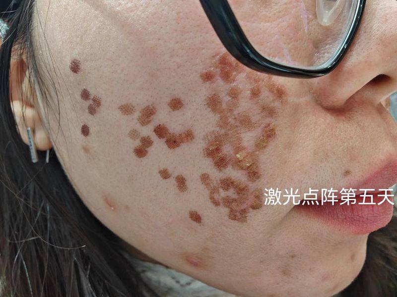 激光祛痘痕大概多少钱