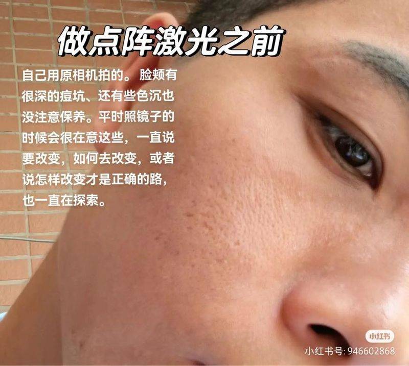 激光祛痘痕大概多少钱