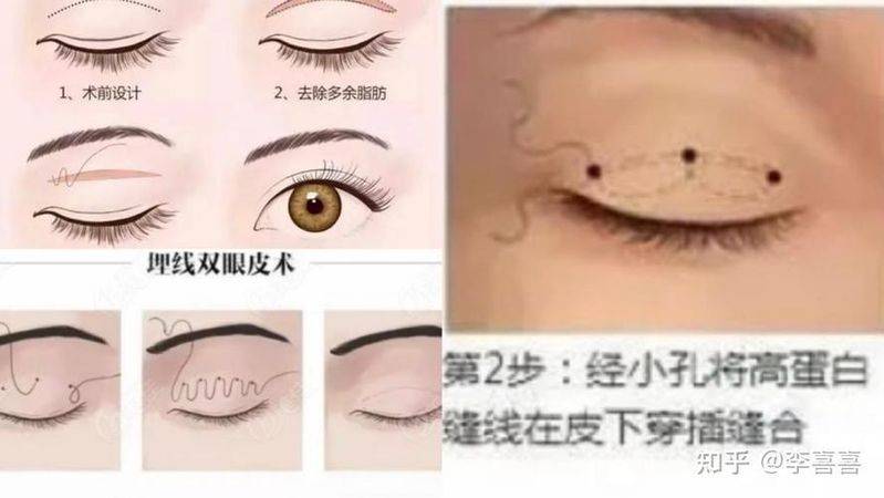 在割个双眼皮多少钱