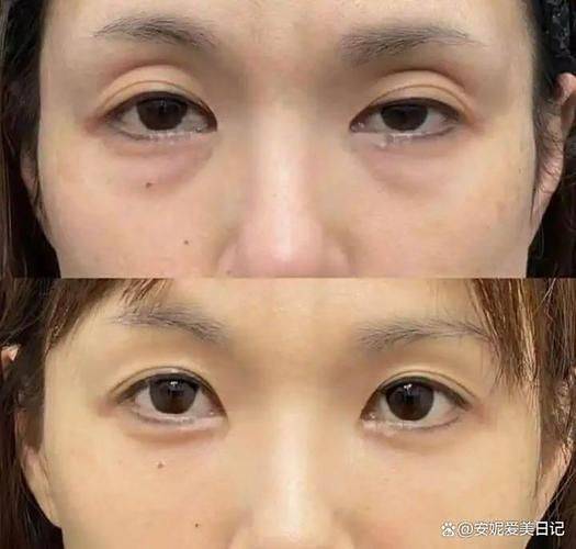 在割个双眼皮多少钱