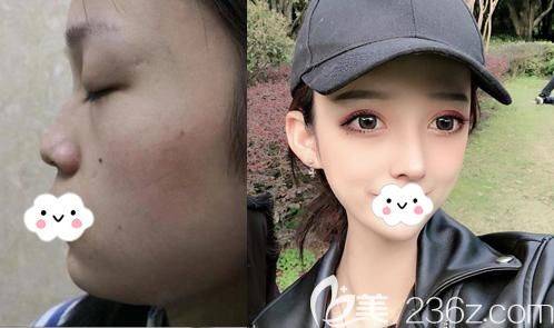 在割个双眼皮多少钱