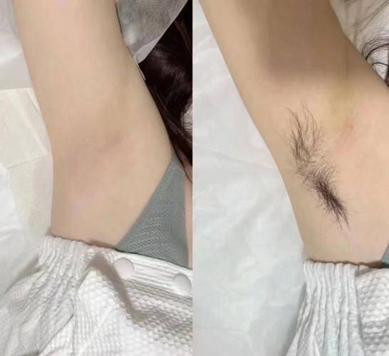 激光脱腋毛费用