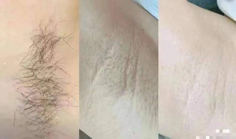 激光脱腋毛费用