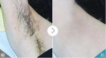 激光脱腋毛费用
