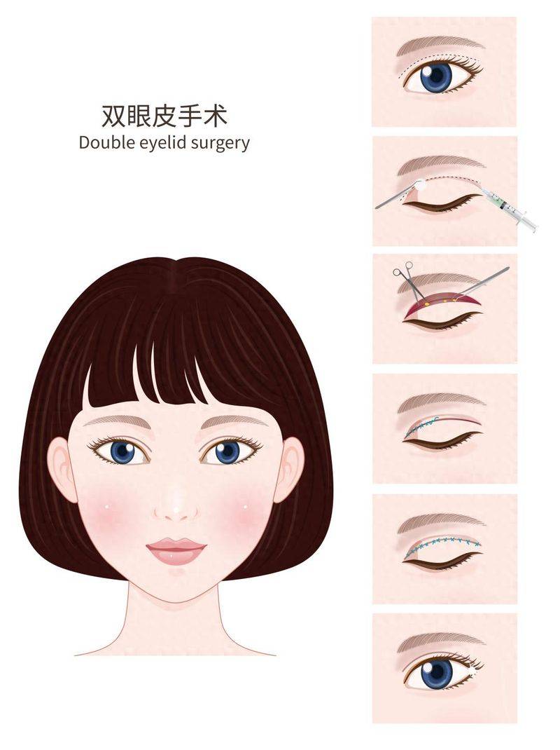 在割个双眼皮多少钱