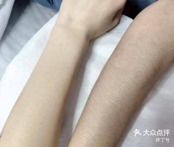 激光脱腋毛费用