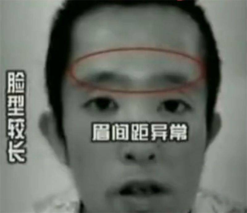 猫叫综合症成因